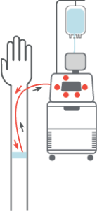 Apheresis Plasma Diagram